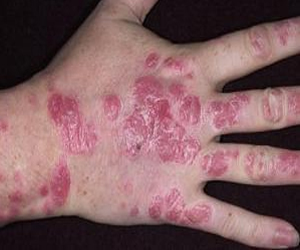   مصر اليوم - مرضى الصدفية الأكثر عرضة للمعاناة من أمراض القلب