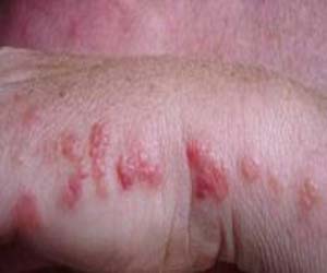 مصر اليوم - مخاطر الحساسية من لسعات الدبابير وسبل علاجها