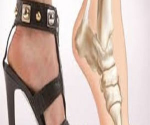   مصر اليوم - تأثير الكعب العالي على السيدات أكثر مما كان متعارفًا عليه