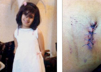   مصر اليوم - اكتشاف رصاصة في أحشاء طفلة سعودية بعد أسبوعين من إصابتها