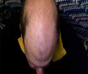   مصر اليوم - الصلع المبكر قد يعد مؤشرًا لمرض التصلب العضلي الجانبي