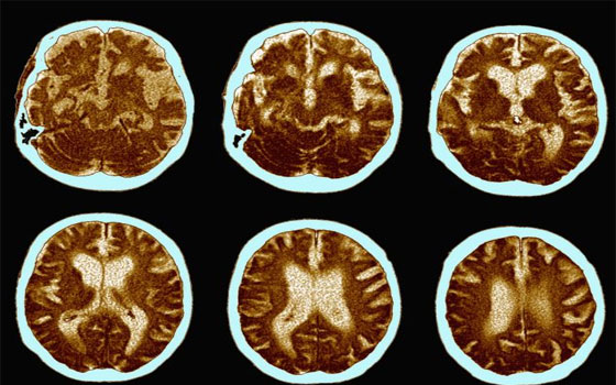 مصر اليوم - علماء أميركيون يكتشفون الحلقة المفقودة التي تسبّب مرض الزهايمر