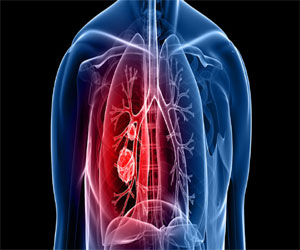   مصر اليوم - الكشف عن سرطان الرئة من خلال هواء الزفير الخاص بالمريض