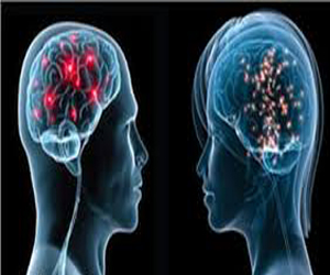   مصر اليوم - باحثون عراقيون يكشفون عن جينات وراثية  لامكانية الاصابة بالسكتة الدماغية