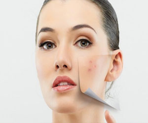 مصر اليوم - 4 وصفات طبيعية للتخلص من آثار حب الشباب