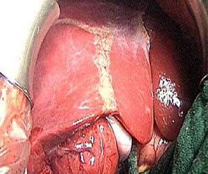 مصر اليوم - مصري يحصل على 4 براءات اختراع لعلاج المصابين بفيروس الكبد