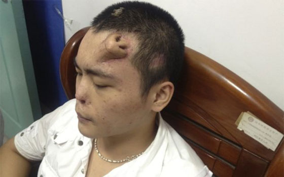 مصر اليوم - زرع أنف جديدة لرجل صيني فوق جبهته بشكل مؤقت