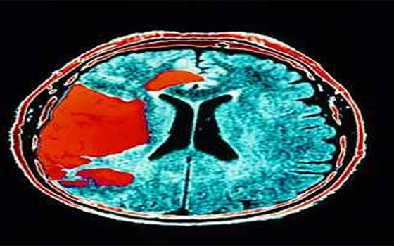 مصر اليوم - تجارب لزراعة جهاز لتحفيز الأعصاب