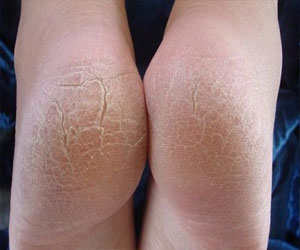   مصر اليوم - اقضي على تشقق الكعبين بزيت النعناع العطري