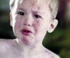 مصر اليوم - إصابة 43 طالبًا بالجدري المائي في سوهاج