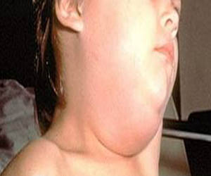   مصر اليوم - إصابةُ 16  طالبًا بالغدةِ النكافيّة في البحرِ الأحمرِ