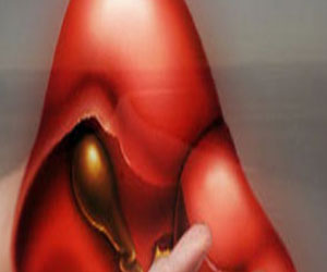   مصر اليوم - اسباب الإصابه بمرض تشمع الكبد والوقاية منه