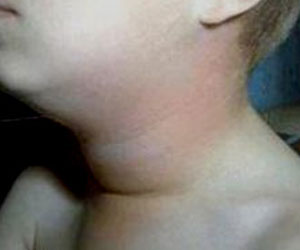   مصر اليوم - أرتفاع حالات الإصابة بالغدة النكافية في القليوبية إلى 193 حالة