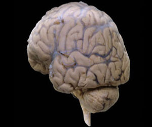   مصر اليوم - مؤسسة طبية ألمانية السكتة الدماغية يمكن أن تصيب صغار السن