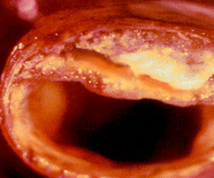   مصر اليوم - الدمام تنظم ندوة بعنوان  أحم نفسك من تصلب الشرايين 