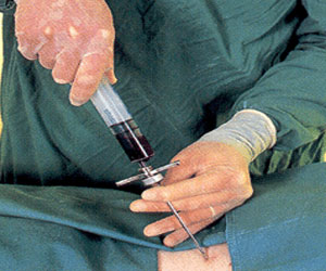   مصر اليوم - زراعة النخاع العظمي تشفي طفلًا من الحساسيةزراعة النخاع العظمي تشفي طفلًا من الحساسية