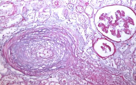 مصر اليوم - علماء أميركيُّون يحدِّدون الجين المُسبِّب للتَّليُّف ويمهِّدون لتطوير الأدوية المعالجة