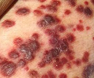   مصر اليوم - سامية عدلي تؤكِّد أن سياسة المغرب تجاه مرض السيدا فاشلة