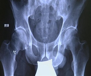   مصر اليوم - كسور مفصل الفخذ وطرق علاجها