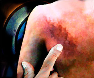   مصر اليوم - الإصابة بالحزام الناري تزيد من خطر الإصابة بالأزمة القلبية