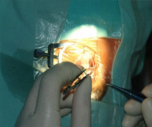   مصر اليوم - تقنية جديدة لتعزز قبول الجسم لقرنية المنزرعة