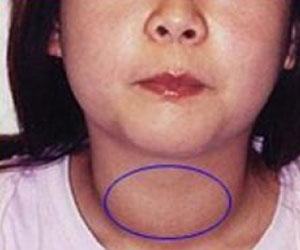   مصر اليوم - خمول الغدة الدرقية الخلقي