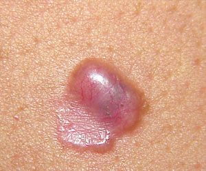   مصر اليوم - انخفاض الوعي بسرطان الجلد بين الأقليات