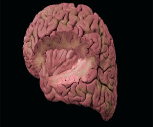   مصر اليوم - علماء يشخصون انفصام الشخصية بطرق حسابية