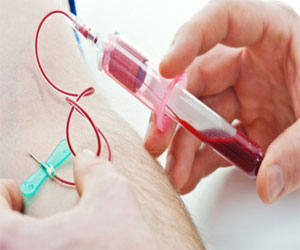   مصر اليوم - تحليل دم مطور للكشف المبكر عن سرطان القولون