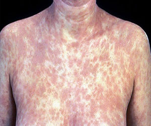 مصر اليوم - دراسة: إرتفاع الاصابة بالزهيرى بنسبة 11% بين الرجال في عام 2012