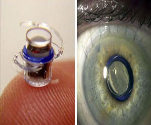   مصر اليوم - زرع تلسكوب دقيق في العين لإعادة الأبصار لمرضى الضمور البقعي