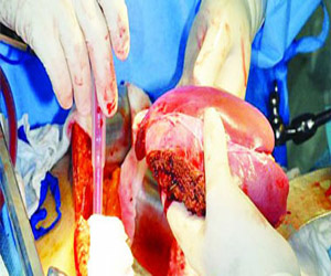   مصر اليوم - إسبانيا الأولى عالميًا فى مجال زراعة الأعضاء خلال العام 2013