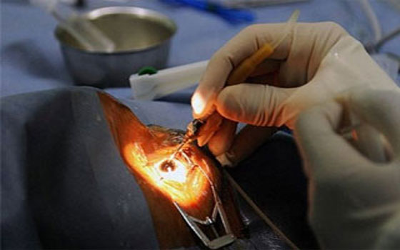 مصر اليوم - علماء يزرعون تليسكوبًا في العين لمواجهة الضُّمور البقعي