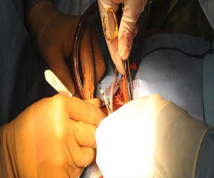 مصر اليوم - جيل لزج يتجمد خلال ثواني لعلاج جرح الأوعية الدموية والقلب