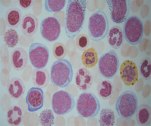   مصر اليوم - اكتشاف طريقة جديدة لعلاج أحد أنواع سرطان الدم