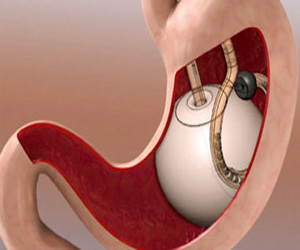   مصر اليوم - كبسولة بالون المعدة الجديدة لتخسيس الوزن