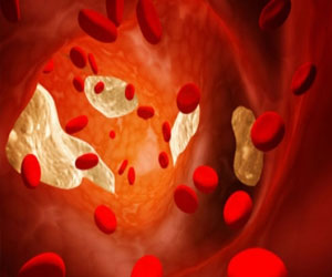   مصر اليوم - مؤتمر يناقش التطورات العلمية في مجال التخثرات الدموية