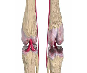   مصر اليوم - العلاج الهرمونى التعويضى يخفض مخاطر الخضوع لجراحات استبدال مفصل الفخذ