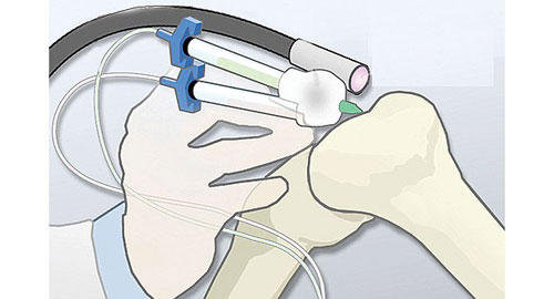   مصر اليوم - قلم بيولوجي لإدخال خلايا بشرية إلى مواقع الجسم المتضررة