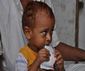   مصر اليوم - وزير الصحة اليمنى يقر معالجة 145 ألف حالة من سوء التغذية الحاد