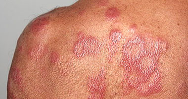   مصر اليوم - حقوق الإنسان تتعهد بدعم الجهود للقضاء على التمييز المتعلق بـالجذام