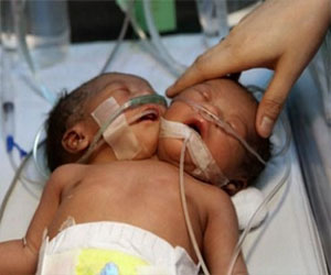   مصر اليوم - ولادة طفل برأسين وجسد واحد في زيمبابوي