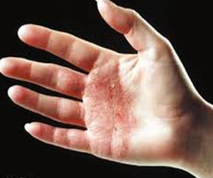   مصر اليوم - مستجدات الأمراض الجلدية مؤتمر في مستشفى الخبر في السعودية