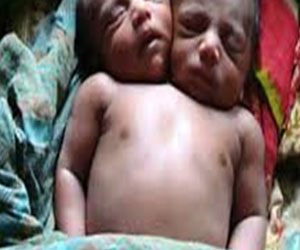   مصر اليوم - ولادة طفل برأسين وجسد واحد في زيمبابوي