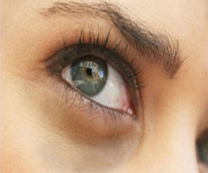   مصر اليوم - طريقك لعلاج الهالات السوداء