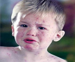   مصر اليوم - مصل ضد فيروس الجدري المائي في فرنسا