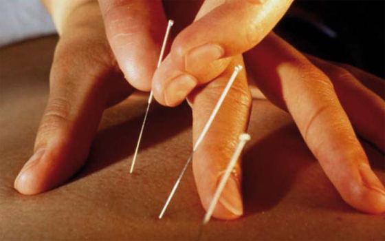   مصر اليوم - الأبحاث الأميركيّة تؤكّد فاعليّة الوخز بالإبر الصينيّة