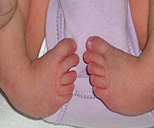   مصر اليوم - 700 مولود سنويًا في لبنان مصاب بمرض القلب الخلقي 