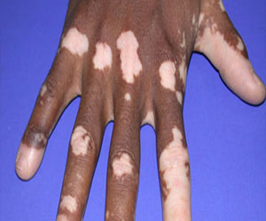   مصر اليوم - الحروق والصدمات العصبية أهم أسباب إصابة البهاق