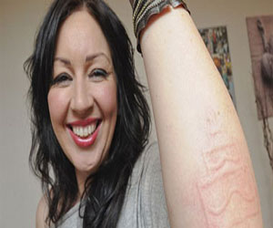   مصر اليوم - بريطانية تعاني من حالة مرضية نادرة تمكنها من الرسم على جلدها